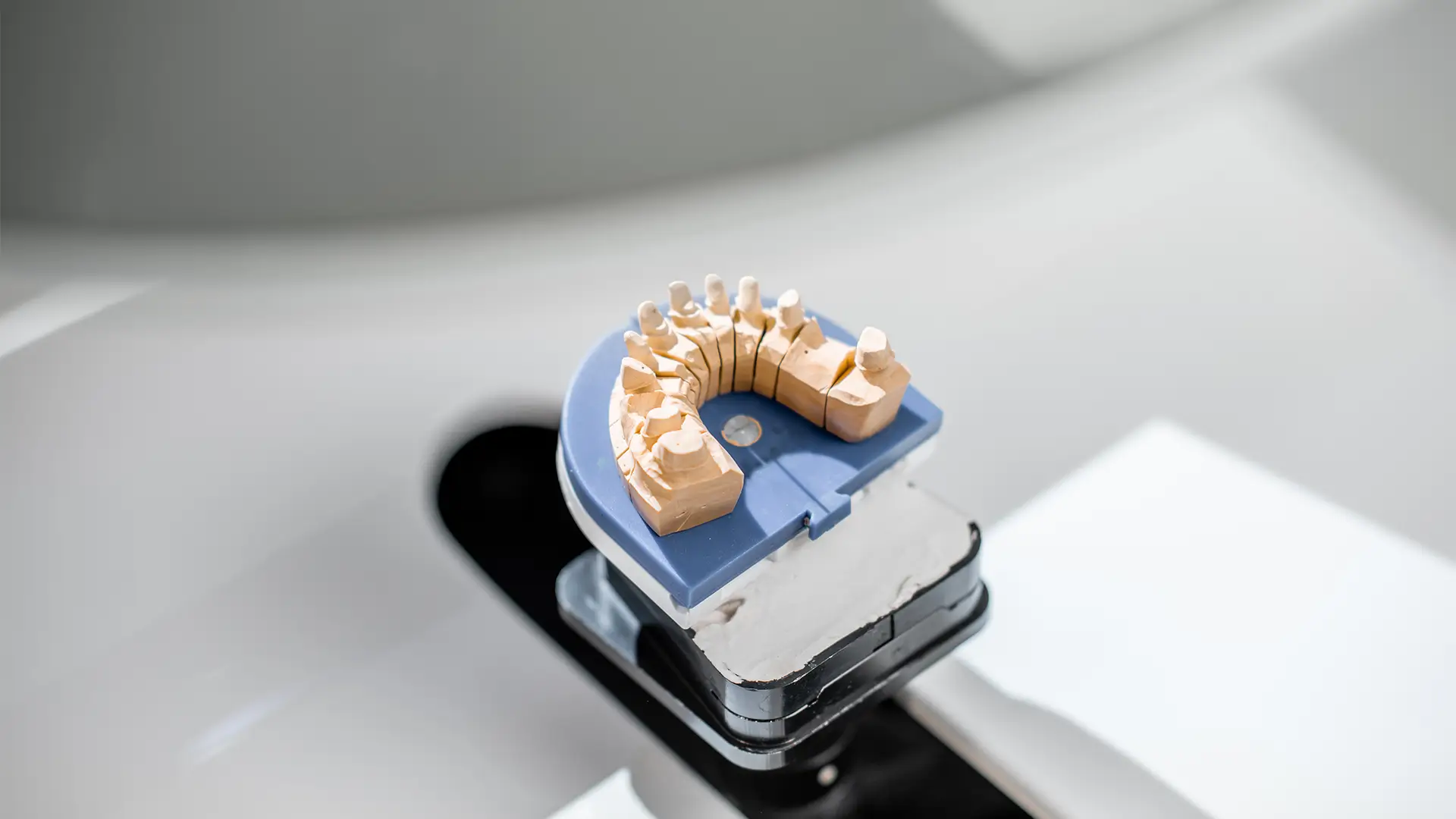 Benefits of 3D Guided Implant Surgery