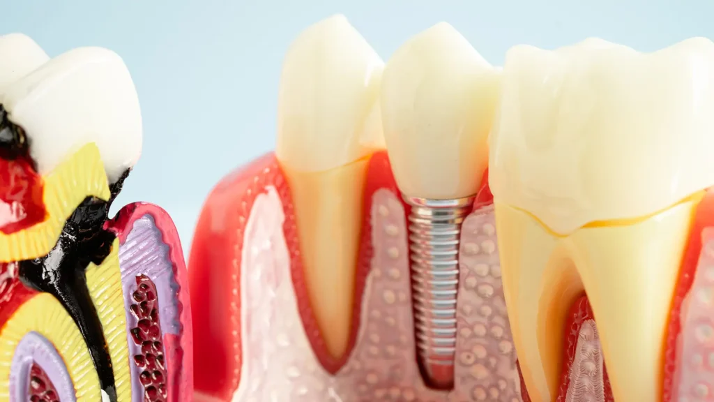 Benefits of All-on-4 Dental Implants