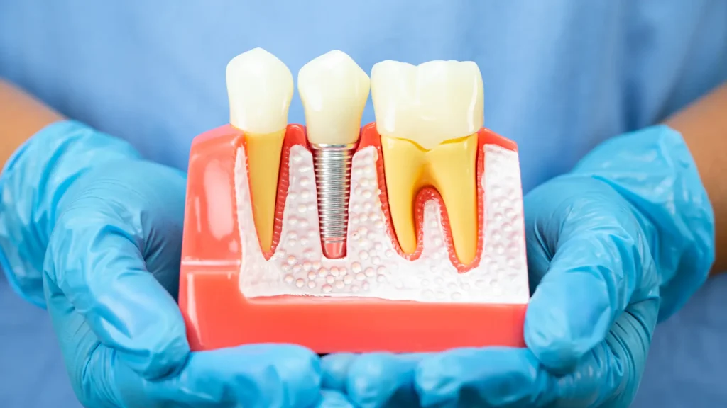 Benefits of All-on-6 Dental Implants