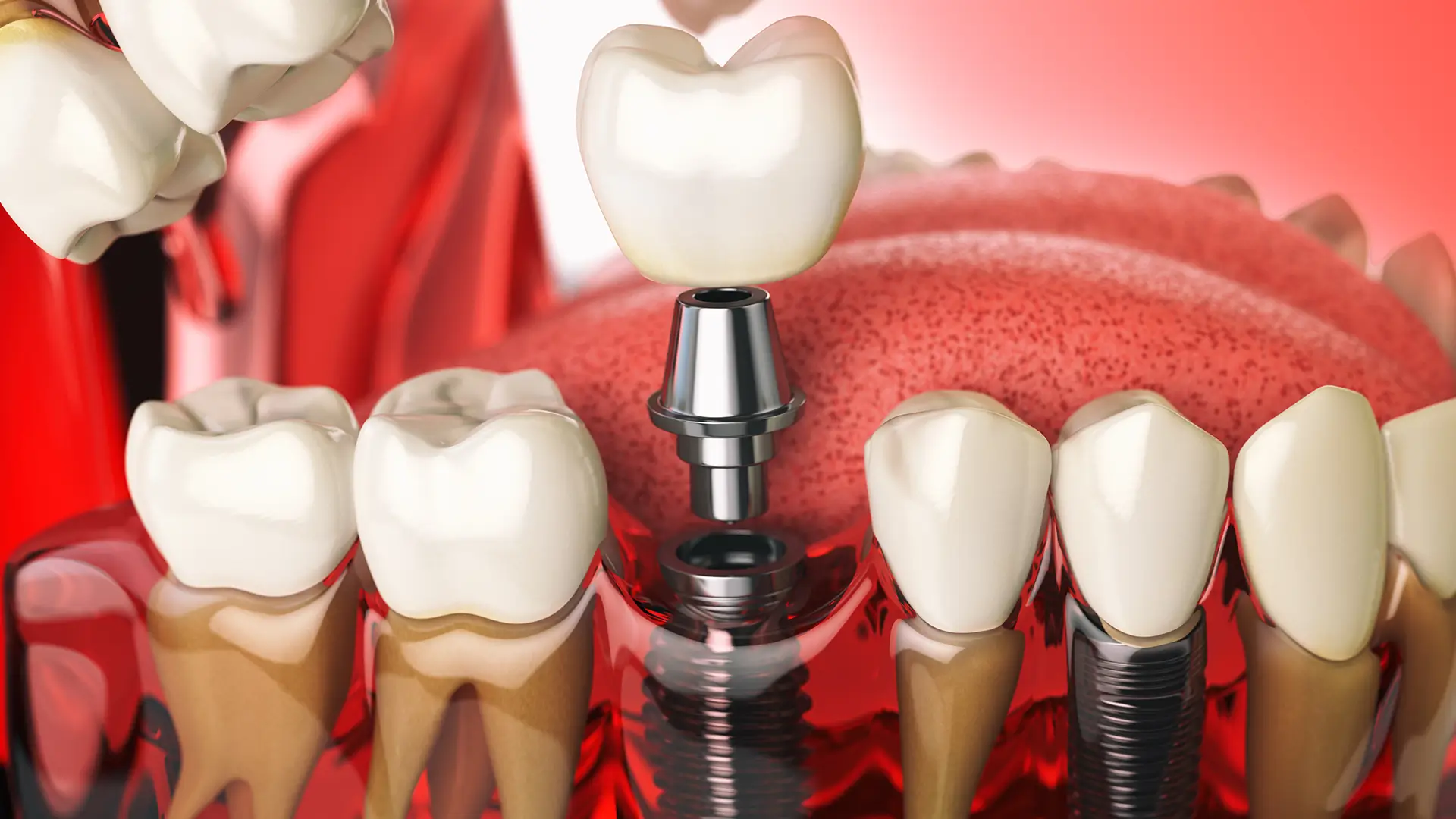 What Are All-on-6 Dental Implants